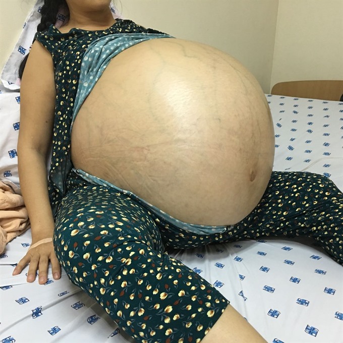 Doctors In Hcm City Remove Massive Ovarian Cyst
