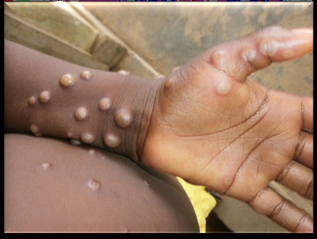 Ministry of Health orders monitoring of suspected Monkeypox cases at border