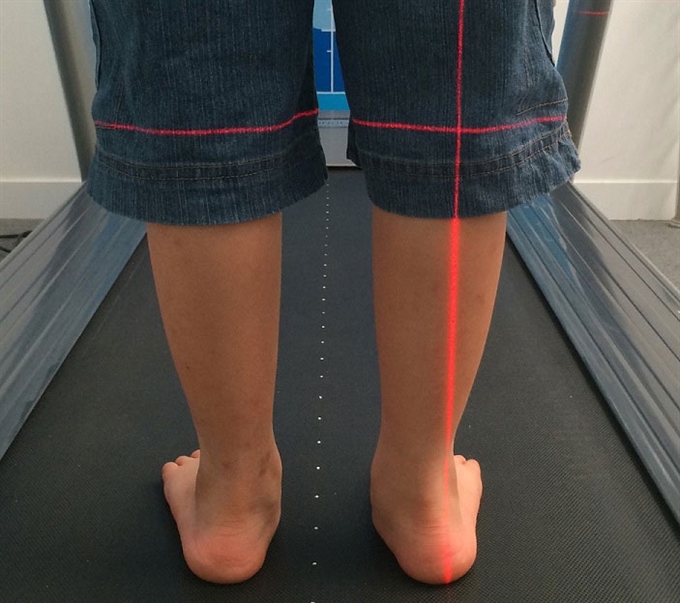 Orthotics Help To Correct Flat Feet